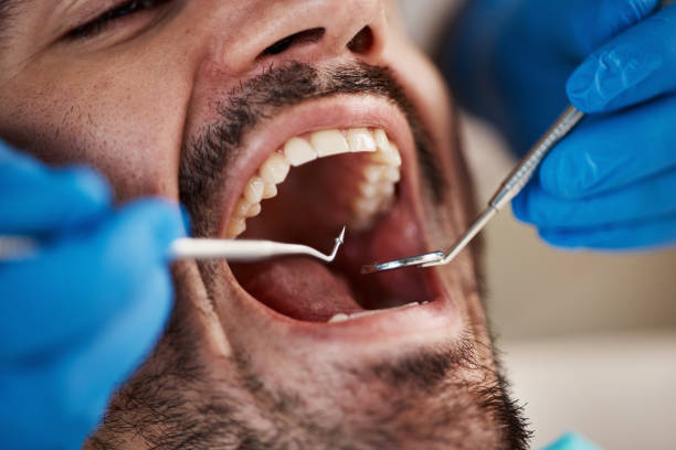 Best Emergency Wisdom Teeth Removal in Edgecliff Village, TX